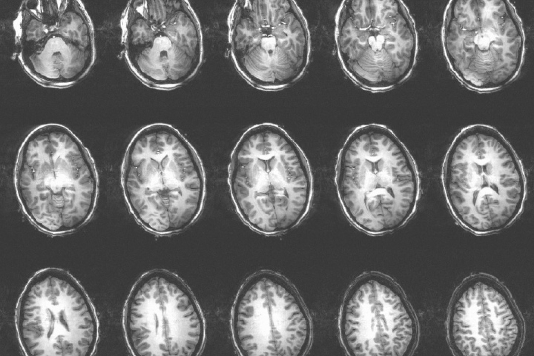 Иллюстрация к новости: Речь как зеркало мышления: приглашение помочь в разработке диагностики и лечения патологий мозга