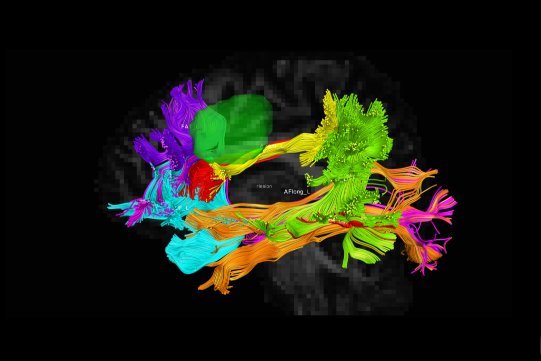 Illustration for news: practical course on diffusion-tensor tractography at the Center for Language and Brain