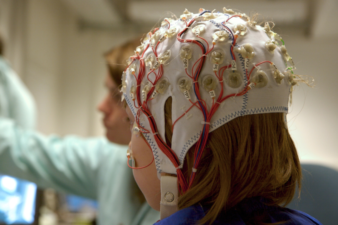 Russian Scientists Create Biomimetic Algorithm to Find Epileptogenic Areas of the Brain