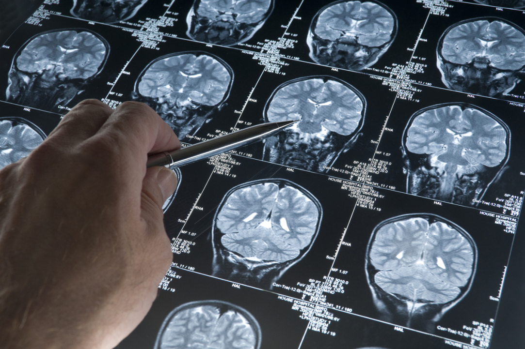 Stimulating the Blood-Brain Barrier Can Help Patients with Alzheimer's